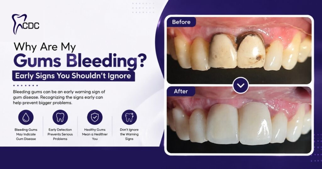Gum Treatment in Navi Mumbai