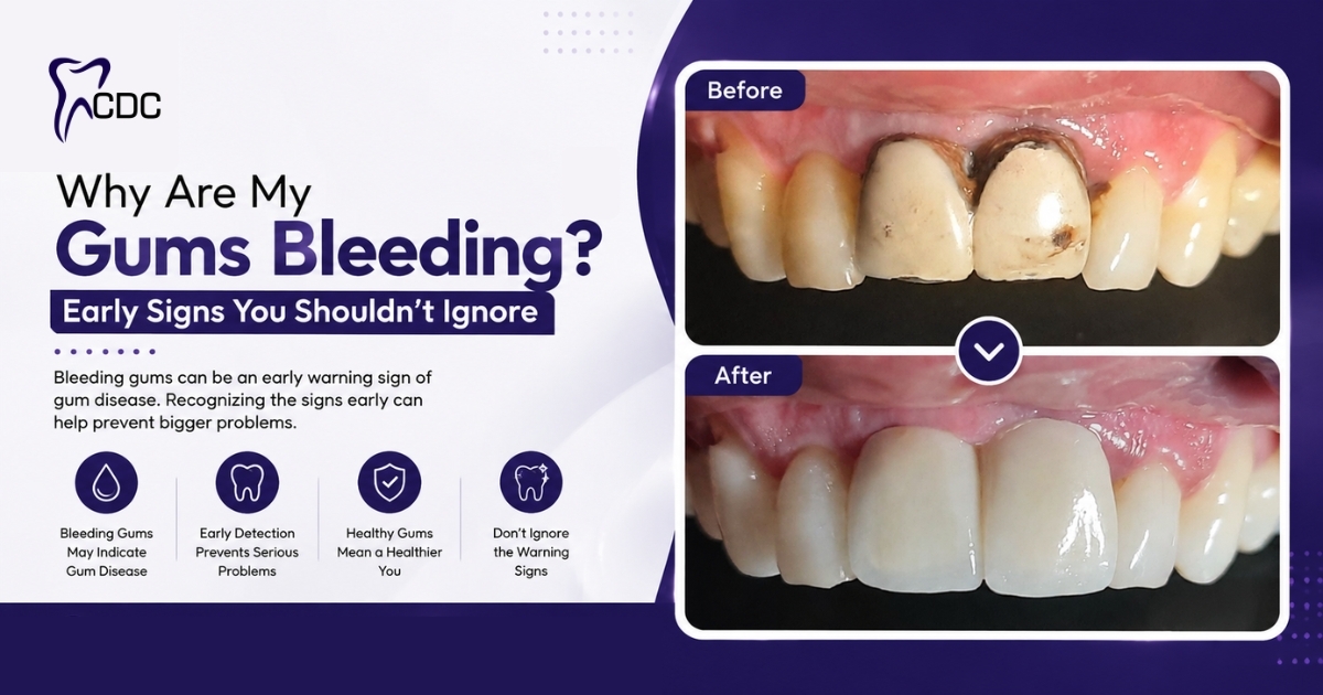 Gum Treatment in Navi Mumbai