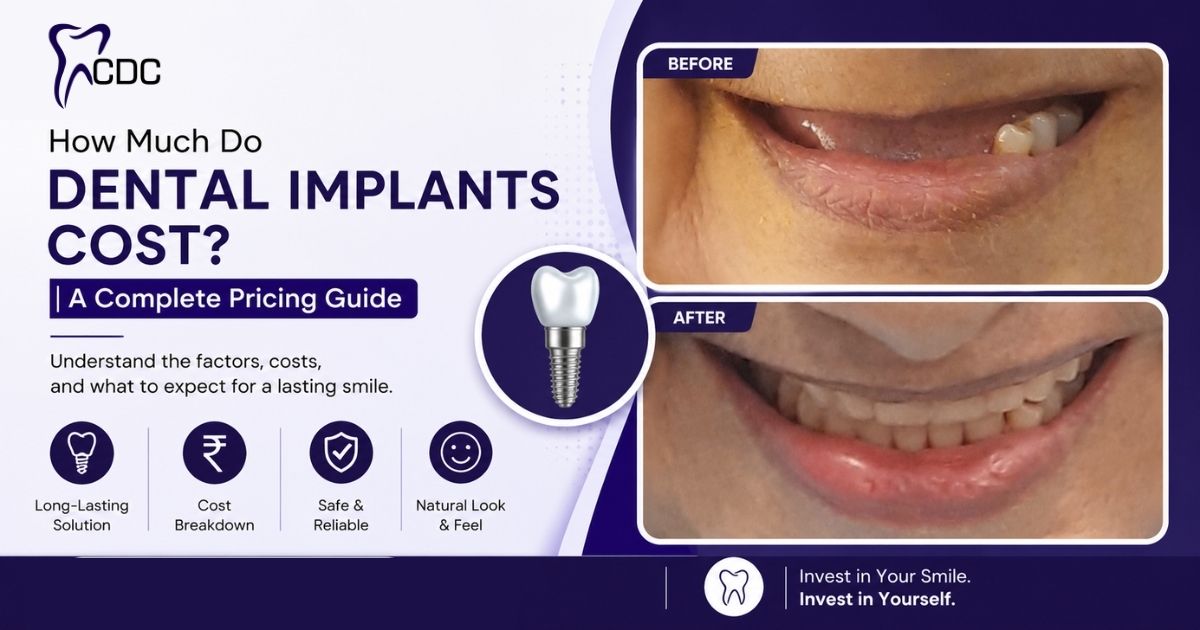 Dental Implants in Navi Mumbai